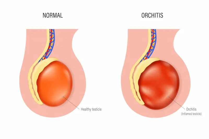Orchitis: Overview of Causes and Treatment